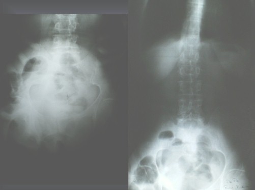 hernia_umbilical_gigante/rx_radiografia_radiologia