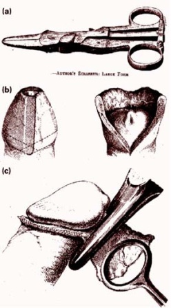 historia_tendencia_circuncision/ecraseur