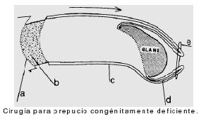 historia_tendencia_circuncision/restauracion_prepucio