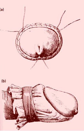 historia_tendencia_circuncision/sutura_doyen