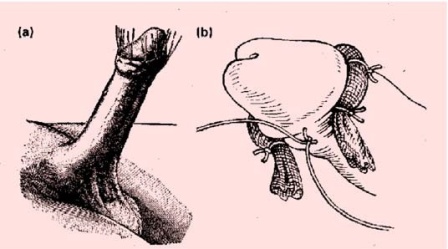 historia_tendencia_circuncision/Técnica_sutura