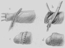 historia_tendencia_circuncision/tecnica_treves historia_tendencia_circuncision/tecnica_treves