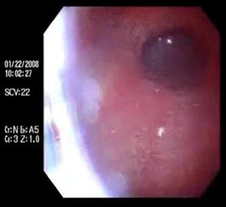 acalasia_enfermedad_Chagas/cavidad_gastrica acalasia_enfermedad_Chagas/cavidad_gastrica