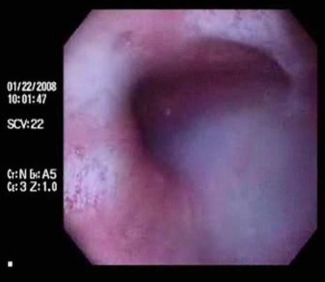 acalasia_enfermedad_Chagas/dilatacion_tercio_medio