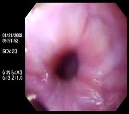 acalasia_enfermedad_Chagas/disminucion_estenosis