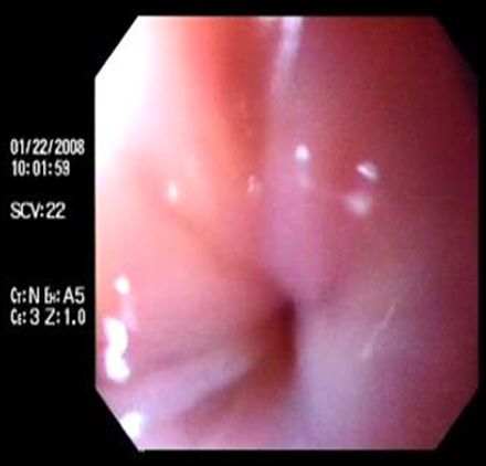 acalasia_enfermedad_Chagas/esfinter_inferior_contraido