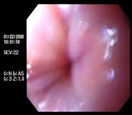 acalasia_enfermedad_Chagas/estenosis_puntiforme acalasia_enfermedad_Chagas/estenosis_puntiforme