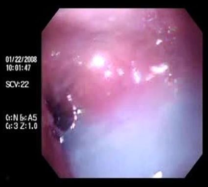 acalasia_enfermedad_Chagas/estenosis_tercio_distal acalasia_enfermedad_Chagas/estenosis_tercio_distal