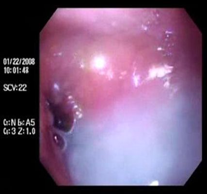 acalasia_enfermedad_Chagas/liquido_estasis acalasia_enfermedad_Chagas/liquido_estasis