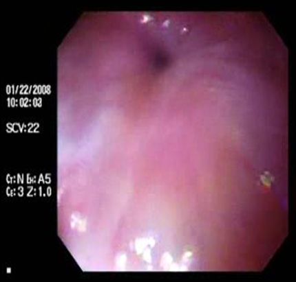 acalasia_enfermedad_Chagas/mucosa_esfinter_contraido acalasia_enfermedad_Chagas/mucosa_esfinter_contraido