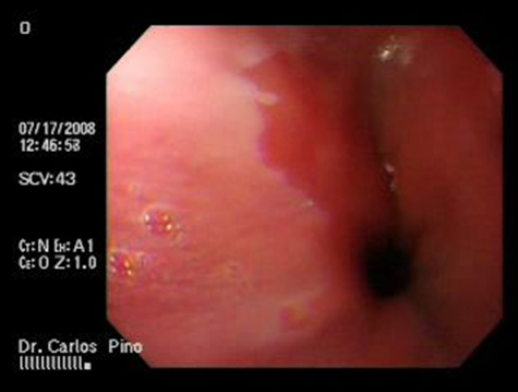 aspectos_endoscopicos_cistogastrostomia/figura_n_1