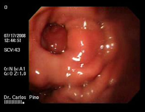 aspectos_endoscopicos_cistogastrostomia/figura_n_2