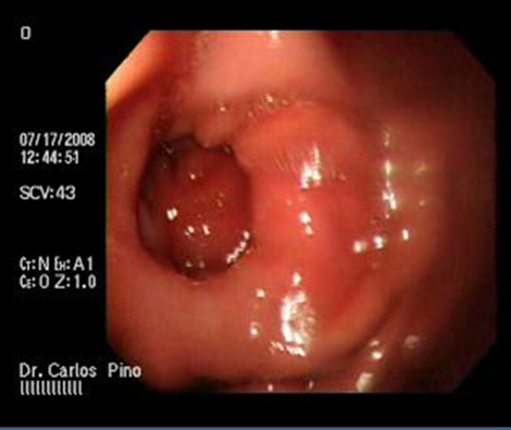aspectos_endoscopicos_cistogastrostomia/figura_n_3 aspectos_endoscopicos_cistogastrostomia/figura_n_3