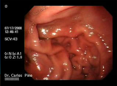 aspectos_endoscopicos_cistogastrostomia/figura_n_4