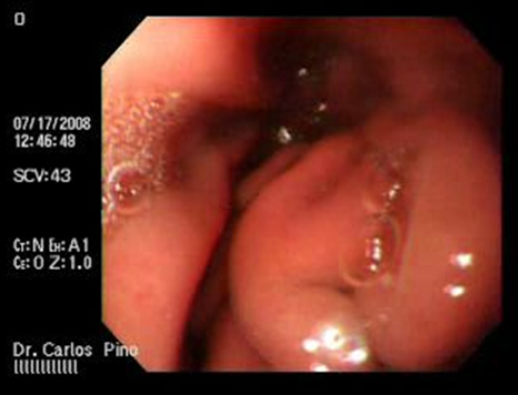 aspectos_endoscopicos_cistogastrostomia/figura_n_5