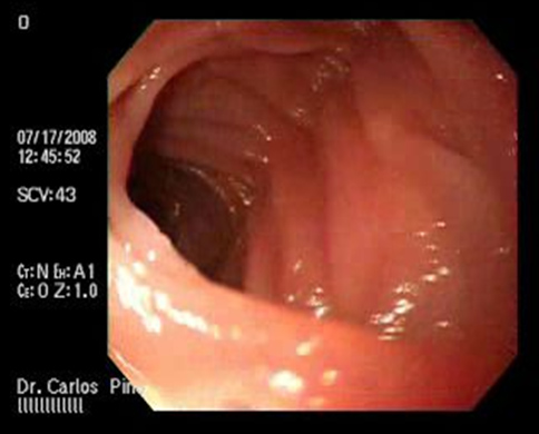 aspectos_endoscopicos_cistogastrostomia/figura_n_7 aspectos_endoscopicos_cistogastrostomia/figura_n_7