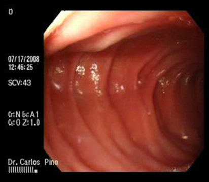 aspectos_endoscopicos_cistogastrostomia/figura_n_8