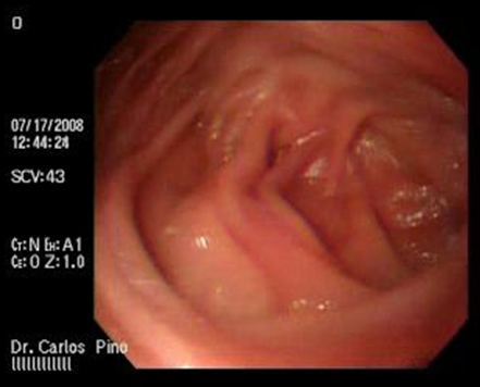 aspectos_endoscopicos_cistogastrostomia/figura_n_9