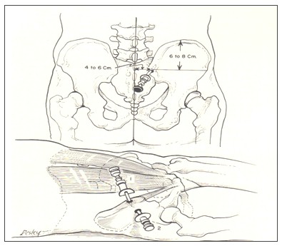 biopsia_medula_osea/cresta_iliaca_puncion biopsia_medula_osea/cresta_iliaca_puncion