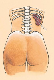 cuidados_enfermeria_urologia/cateter_nefrostomia_renal