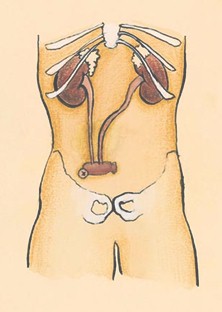 cuidados_enfermeria_urologia/ureter_ureterostomia_ileocecal