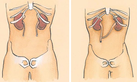 cuidados_enfermeria_urologia/ureter_ureterostomia_percutanea