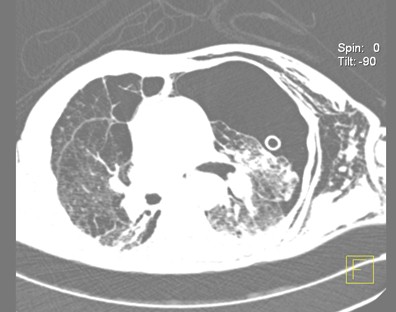 enfisema_subcutaneo_neumotorax/TAC_colapso_pulmonar