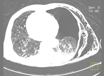 enfisema_subcutaneo_neumotorax/TAC_desplazamiento_mediastinico