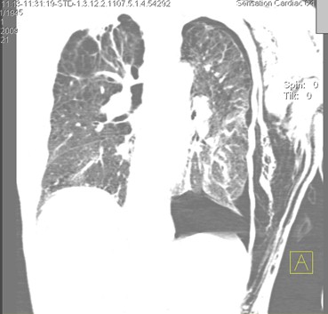 enfisema_subcutaneo_neumotorax/TAC_pneumotorax_toracico