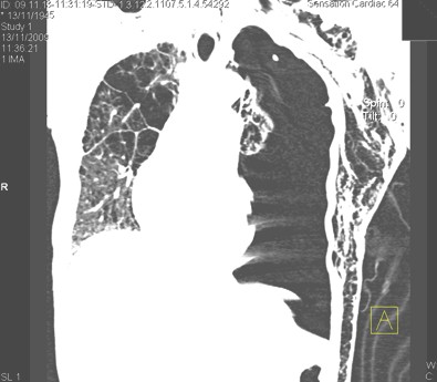 enfisema_subcutaneo_neumotorax/TAC_traumatismo_toracico enfisema_subcutaneo_neumotorax/TAC_traumatismo_toracico