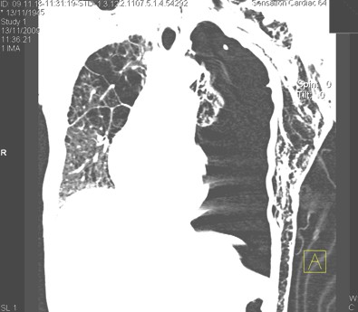 enfisema_subcutaneo_neumotorax/TAC_traumatismo_toracico