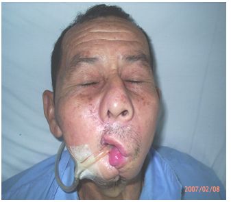 herida_arma_fuego/4_meses_1 herida_arma_fuego/4_meses_1