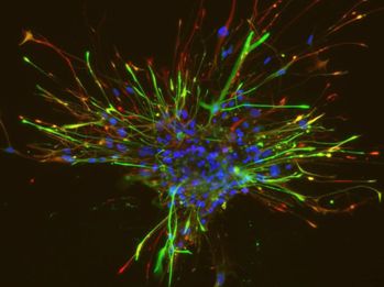 imagenes_cientificas_histologia/tumoresfera_glioblastoma