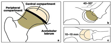 artroscopia_atrapamiento_femoroacetabular/artroscopia_de_cadera