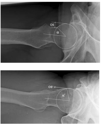 artroscopia_atrapamiento_femoroacetabular/atrapamiento_cam_lateral