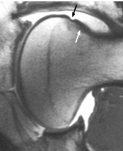 artroscopia_atrapamiento_femoroacetabular/atrapamiento_pincer_zoom