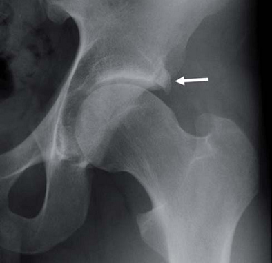 artroscopia_atrapamiento_femoroacetabular/atrapamiento_tipo_pincer