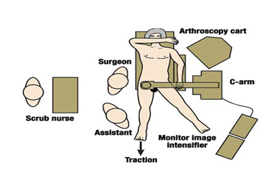 artroscopia_atrapamiento_femoroacetabular/posicion_del_artroscopio