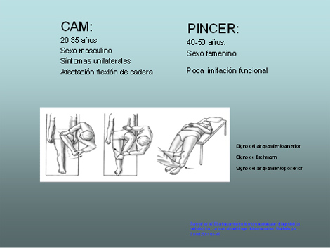 artroscopia_atrapamiento_femoroacetabular/proyeccion_para_tac
