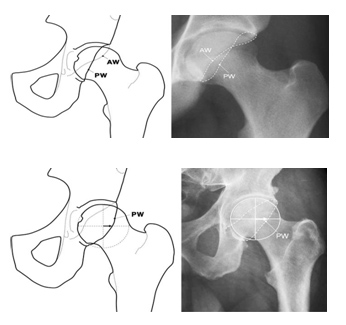 artroscopia_atrapamiento_femoroacetabular/signo_muro_posterior