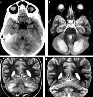 complicaciones_neurologicas_micoplasma/TAC_infeccion_pneumoniae complicaciones_neurologicas_micoplasma/TAC_infeccion_pneumoniae