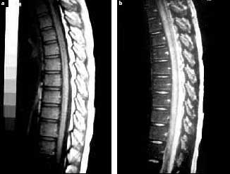 complicaciones_neurologicas_micoplasma/condensacion_focos_captadores