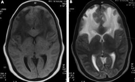 complicaciones_neurologicas_micoplasma/desmielinizacion_bilateral_frontales