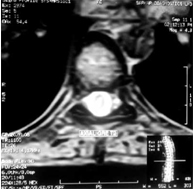 complicaciones_neurologicas_micoplasma/hipertensa_ADEM_mielitis complicaciones_neurologicas_micoplasma/hipertensa_ADEM_mielitis