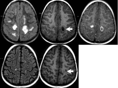 complicaciones_neurologicas_micoplasma/lesion_asimetrica_supratentorial