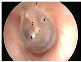 otitis_media_aguda/otoscopia_2 otitis_media_aguda/otoscopia_2