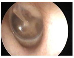 otitis_media_aguda/otoscopia_3 otitis_media_aguda/otoscopia_3