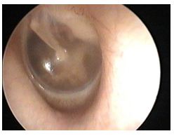 otitis_media_aguda/otoscopia_3