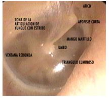 otitis_media_aguda/otoscopia_4 otitis_media_aguda/otoscopia_4