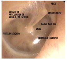 otitis_media_aguda/otoscopia_4